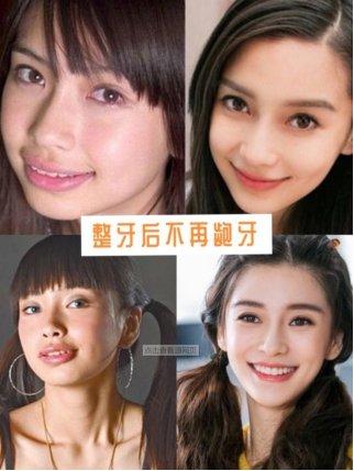 正畸有年齡限制嗎