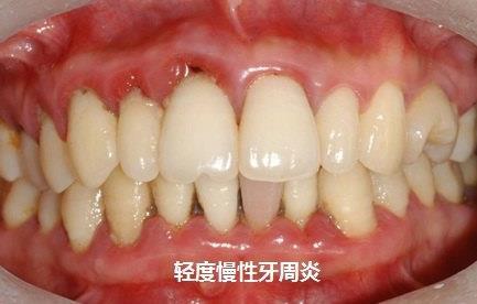 有牙周病的可以做正畸嗎