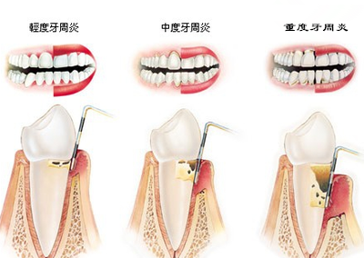 牙周炎牙齒松動可以正畸嘛