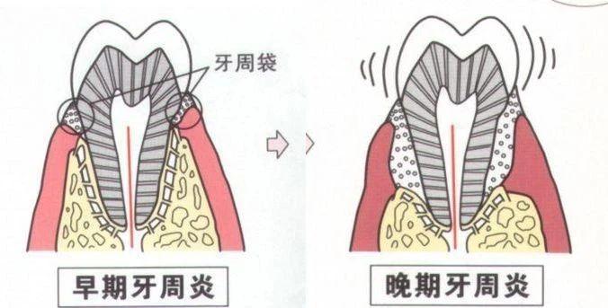 牙周炎