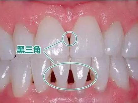 黑三角