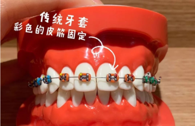 傳統(tǒng)矯正器