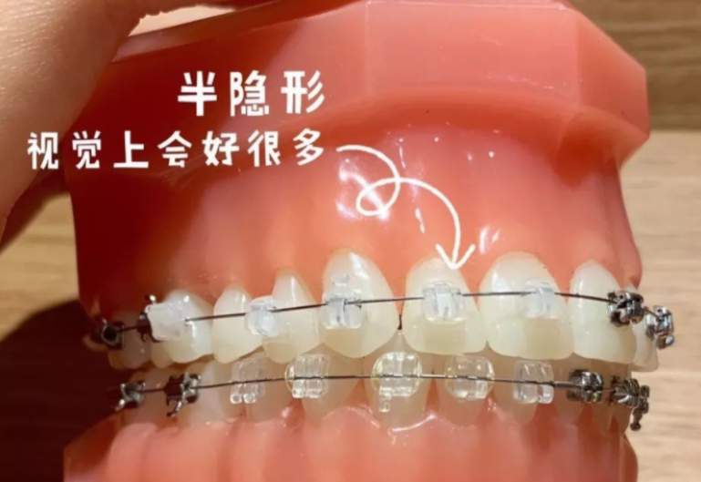 傳統(tǒng)陶瓷自鎖式矯正器
