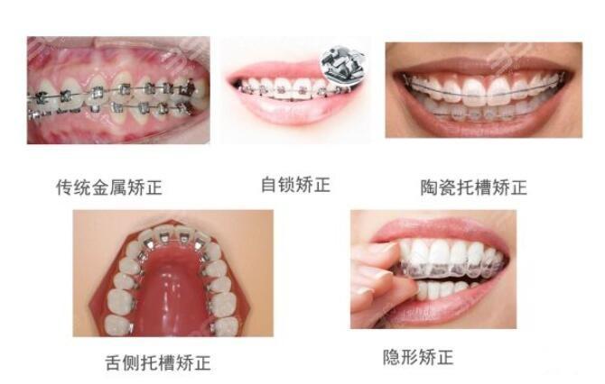 矯正牙齒一般要花多少錢(qián)