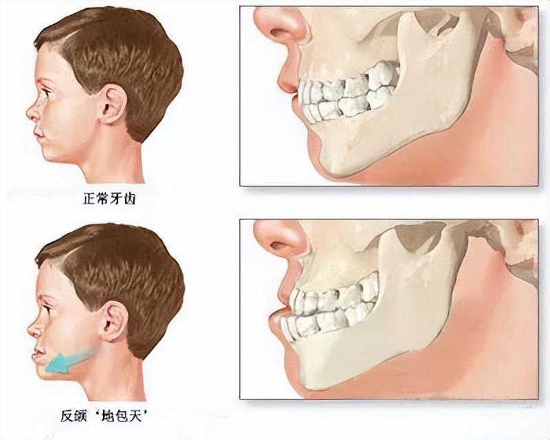 地包天牙齒矯正