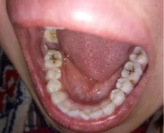 洗牙的噴頭傳染病嗎
