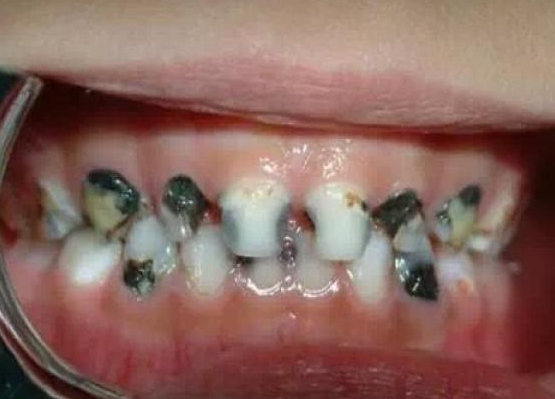 牙髓炎治療痛不痛
