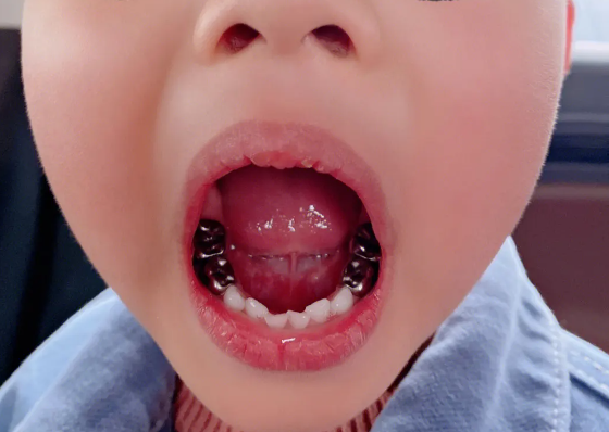 小孩牙髓炎癥狀