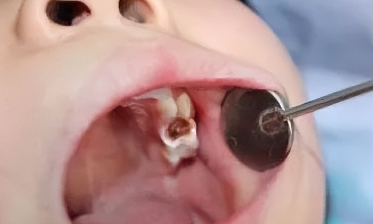 牙髓炎治療要多少錢