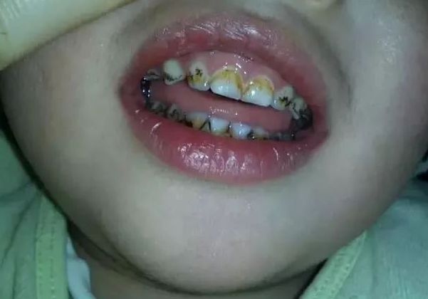 急性牙髓炎一般疼幾天