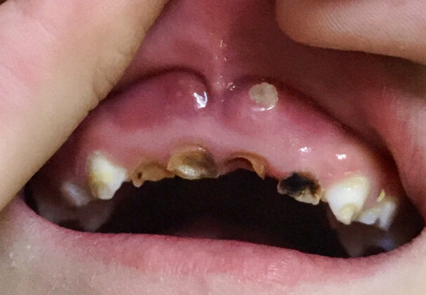 牙髓炎治療后為什么還痛