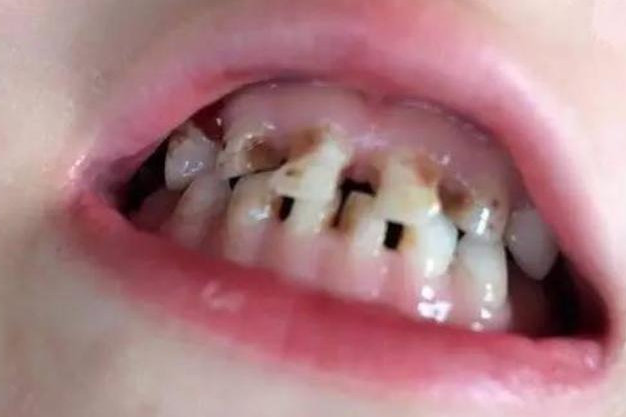 牙周炎治療一般需要幾次