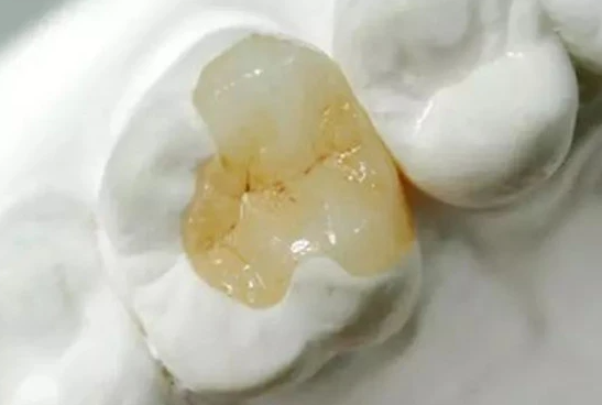 矯正牙齒的種類和價(jià)格