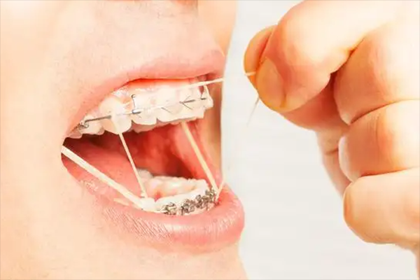 舌內(nèi)側(cè)矯正牙齒價(jià)格