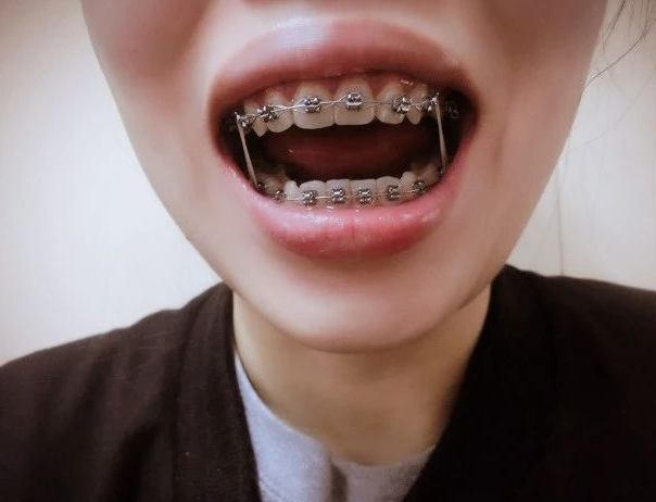 進(jìn)口托槽矯正牙齒價(jià)格