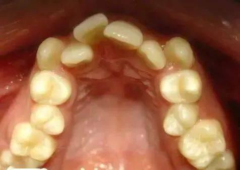 成人牙齒矯正拔牙價(jià)格