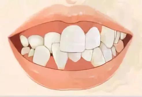 兒童口腔早期矯正牙齒價(jià)格