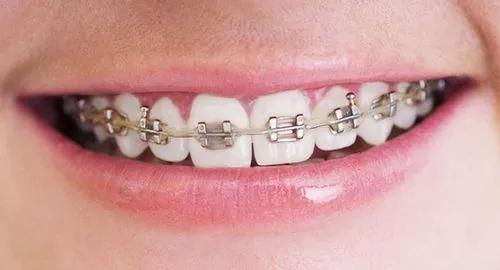 牙齒矯正后保持器的價(jià)格