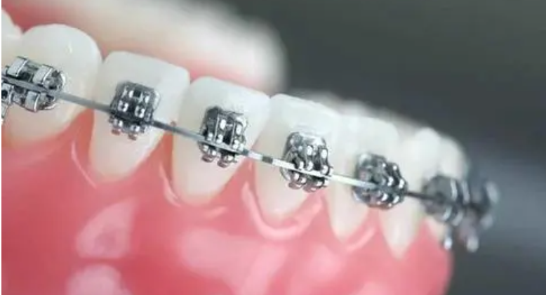 牙齒矯正后保持器的價(jià)格