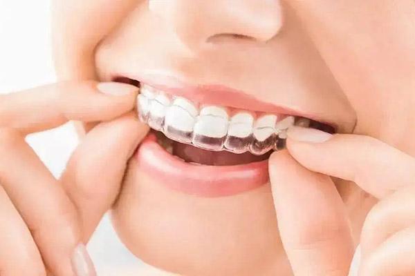 牙齒矯正器種類和價格