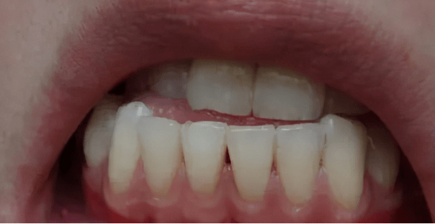 小孩牙齒反頜矯正的價(jià)格