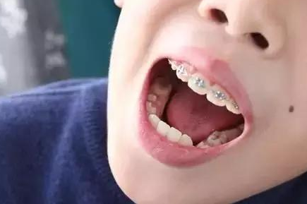 兒童整牙齒矯正價(jià)格