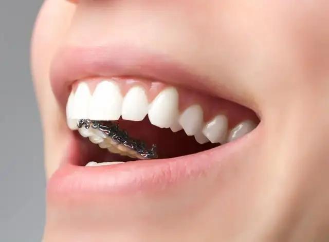 矯正牙齒外突價格