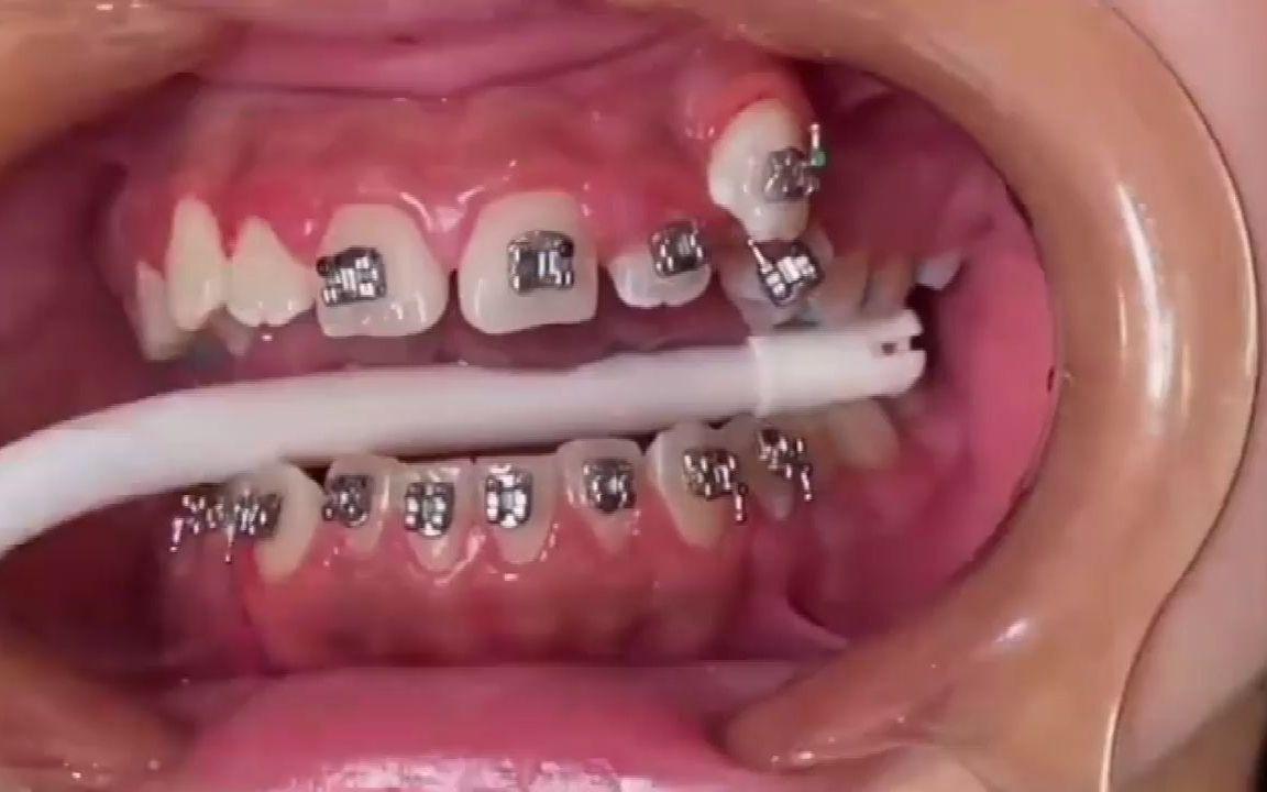 牙齒矯正分類價(jià)格