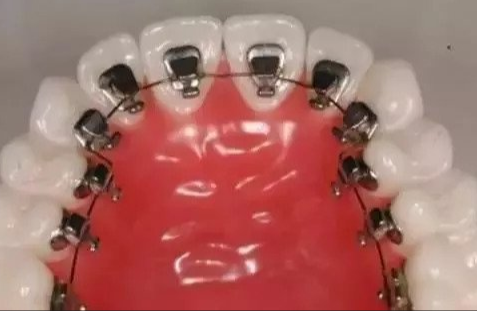 牙齒外翻矯正價格