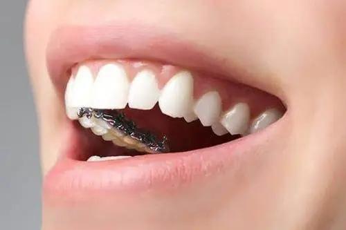 牙齒矯正器脫落了要怎么辦