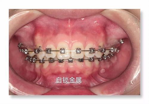 牙齒外凸的矯正方法