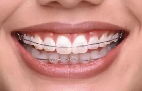 年齡大了矯正牙齒的可行性