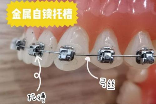 牙齒矯正的其他注意事項(xiàng)