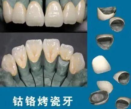 鈷鉻烤瓷牙的使用壽命