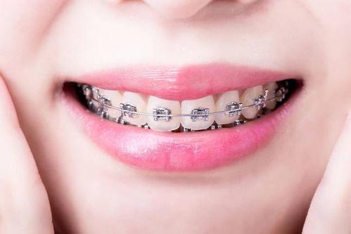 可以考慮拔牙矯正的情況
