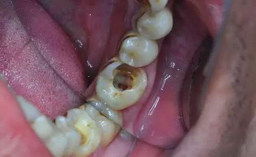 預(yù)防齲齒的方法