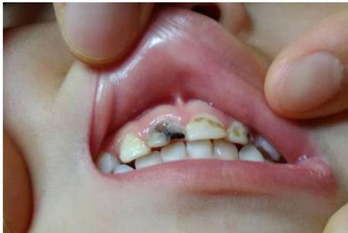 兒童補牙后的注意事項