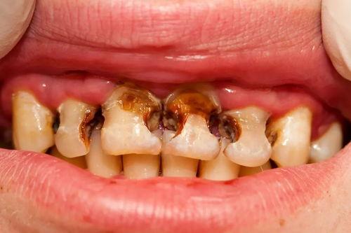 死髓牙的治療方法