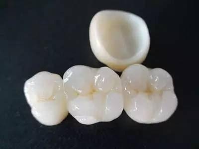 烤瓷牙好壞的關(guān)鍵因素