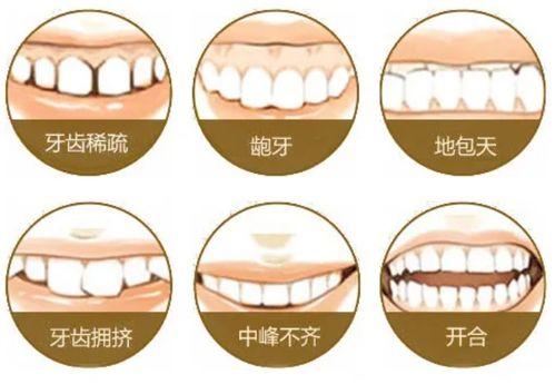 牙頜畸形的常見類型及表現(xiàn)