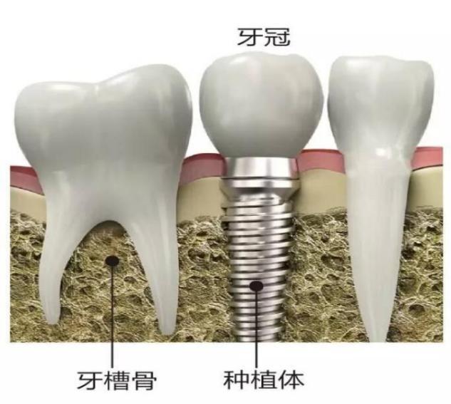 種牙時(shí)牙齦發(fā)炎的原因及應(yīng)對(duì)措施