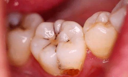 蛀牙的治療方法
