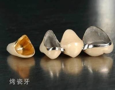 烤瓷牙松動(dòng)的原因及影響