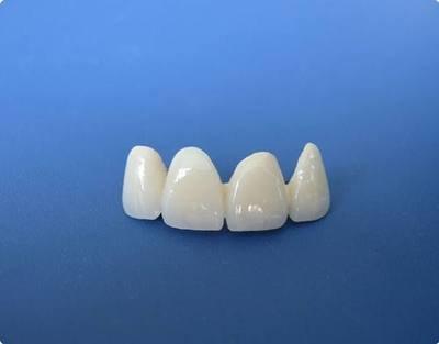 判斷烤瓷牙好壞的標(biāo)準(zhǔn)