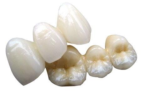全瓷牙的優(yōu)缺點(diǎn)