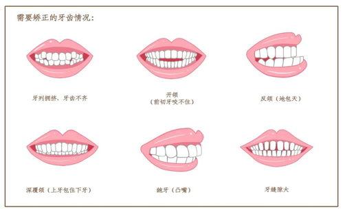 錯(cuò)頜畸形的類(lèi)型
