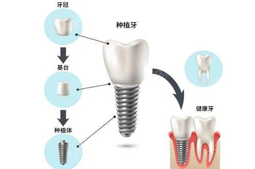 天然牙與種植牙的區(qū)別