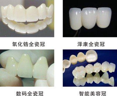 做全瓷冠后注意事項