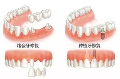 常見的牙齒修復(fù)方式
