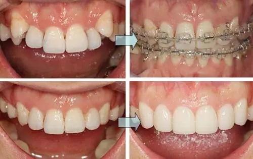 牙齒矯正的適宜年齡